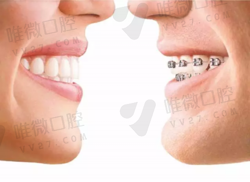 胶托活动假牙使用方法（活动假牙是怎么固定的图片）(图1)